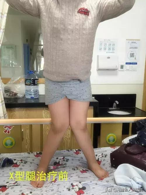 宝宝脚尖站立的原因,宝宝脚尖对脚尖走路怎么回事