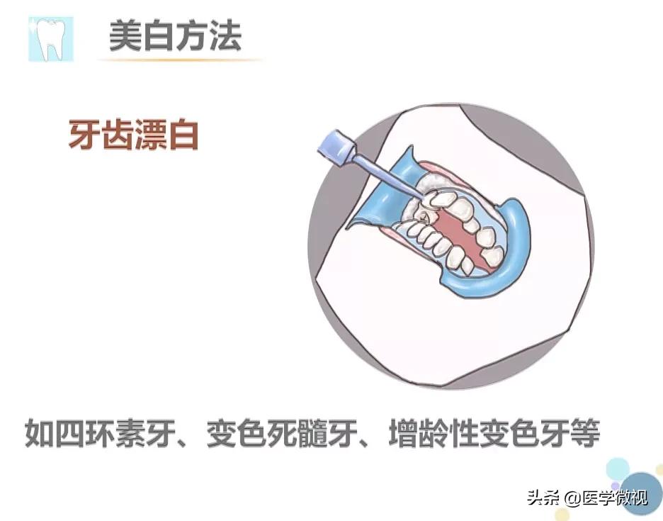 牙膏美白牙齿真的靠谱吗,美白牙膏可不可靠