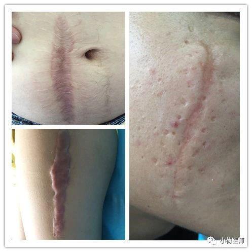 烧伤疤痕后遗症怎么治,烧伤愈合后疤痕处理案例