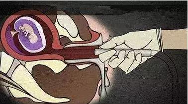 2018年ACOG“早孕期妊娠丢失”指南要点解读