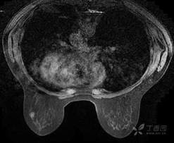 乳腺结节有消散的病例吗,一份完整的乳腺增生病例