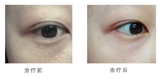 小孩眼周长扁平的疙瘩是怎么回事,眼周有小疙瘩用什么药物可以去除