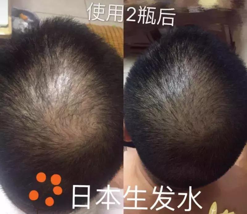 发际线高头发稀疏掉头发怎么拯救,发际线后移的头发还能长出来么