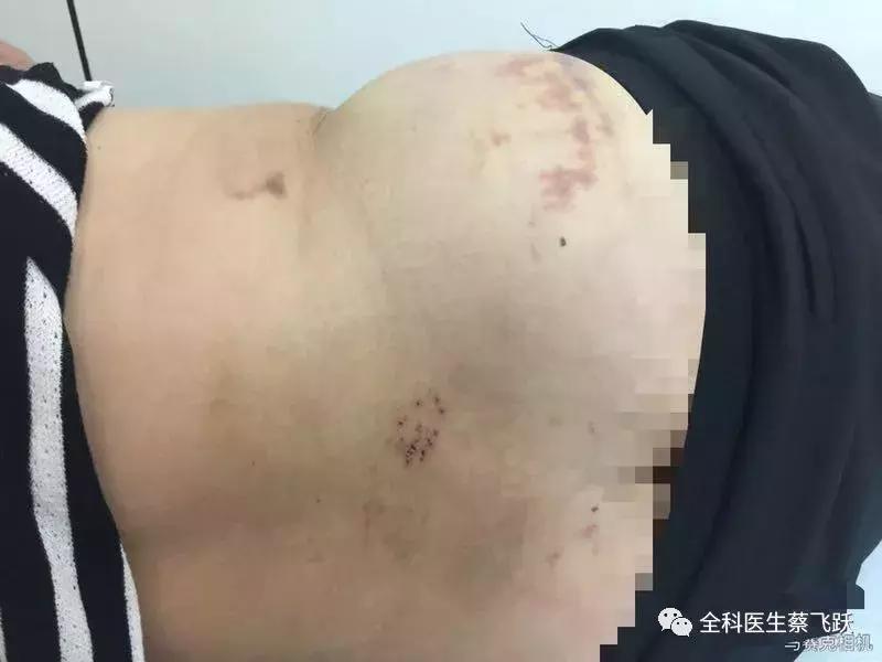 痛得像针扎火烧，她去看病，臀部反被“打”出一片淤伤…