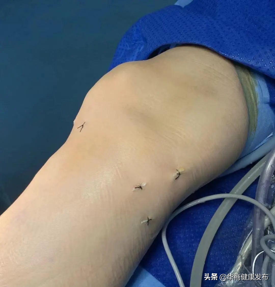 脚膝盖腘窝囊肿手术要注意什么,腘窝囊肿关节镜切除