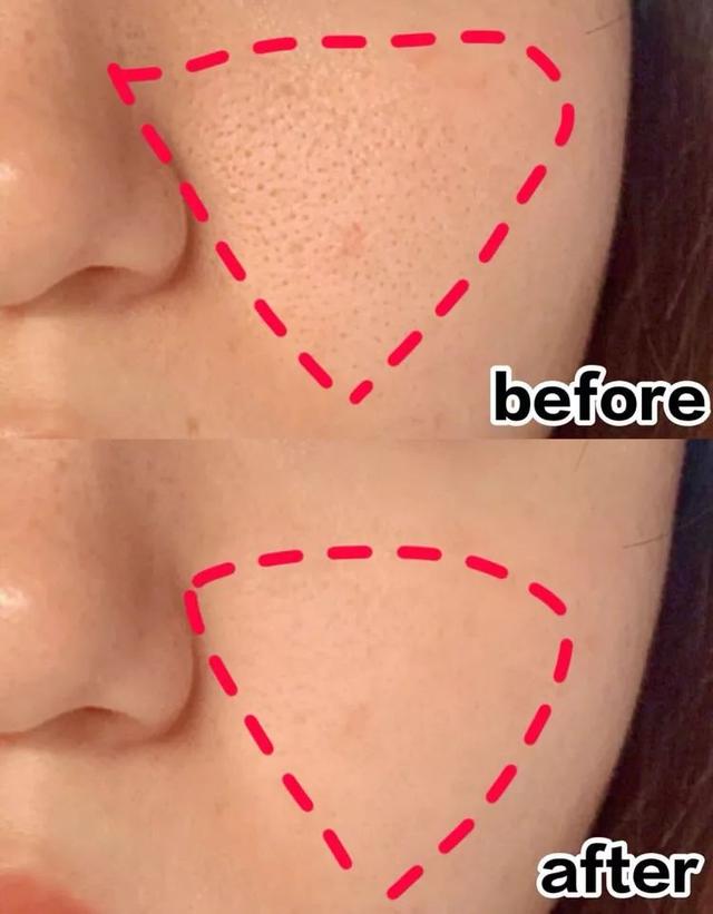 闭口粉刺怎么导致的,闭口粉刺和闭口的区别