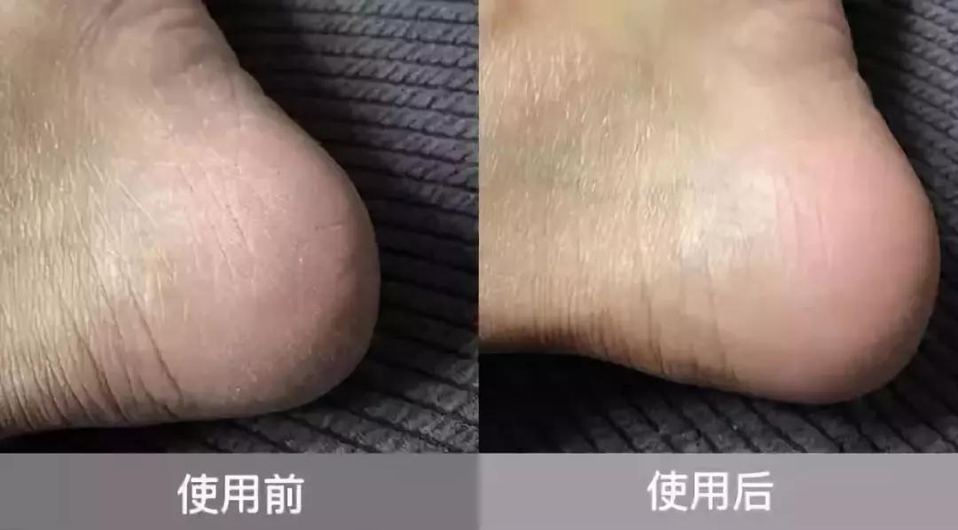 加拿大皲裂霜,加拿大修复膏