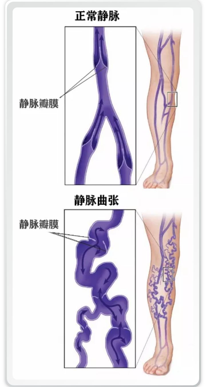 静脉曲张你了解多少,静脉曲张怎么治最好