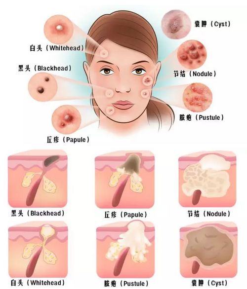 哪些问题属于内分泌失调,肠道菌群失调与甲状腺疾病有关