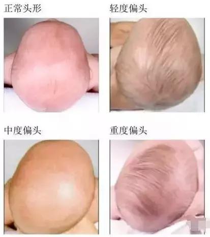 让孩子睡出完美头型的五个方法,小孩头型睡偏了几岁前能睡过来
