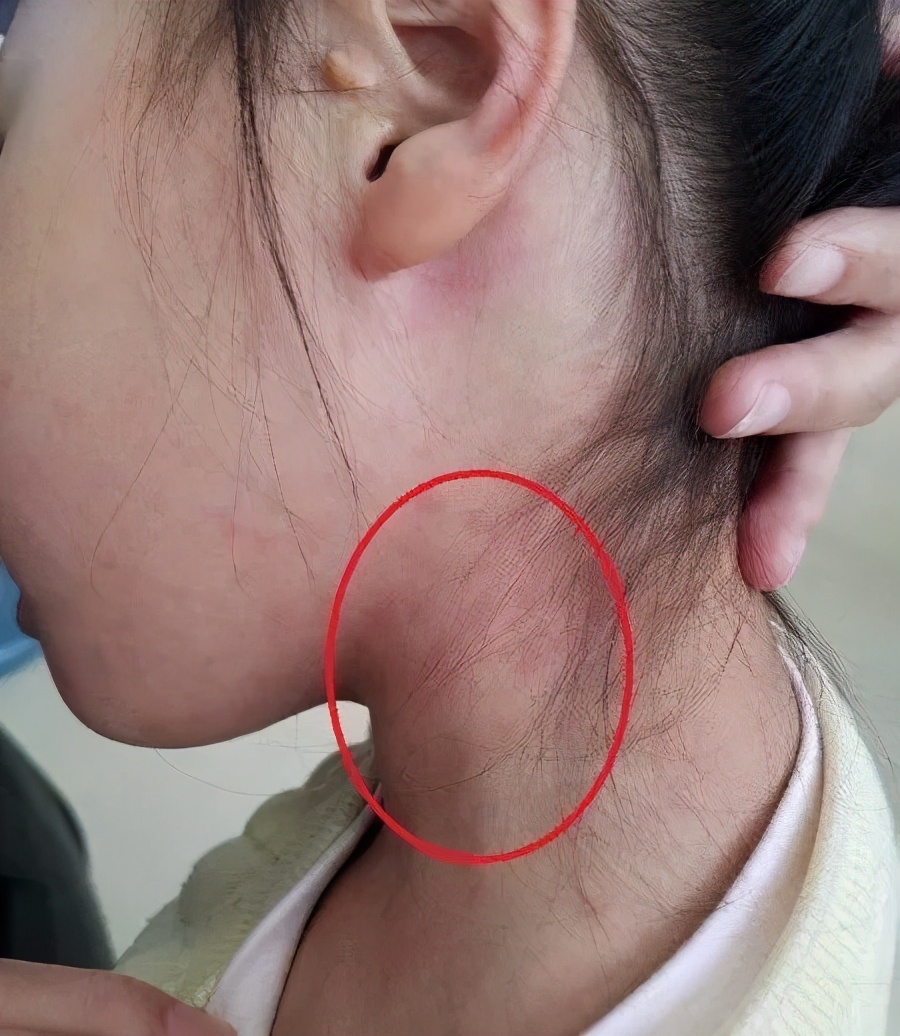 孩子反复高烧是吓到了吗,儿童高烧反复要警惕什么病