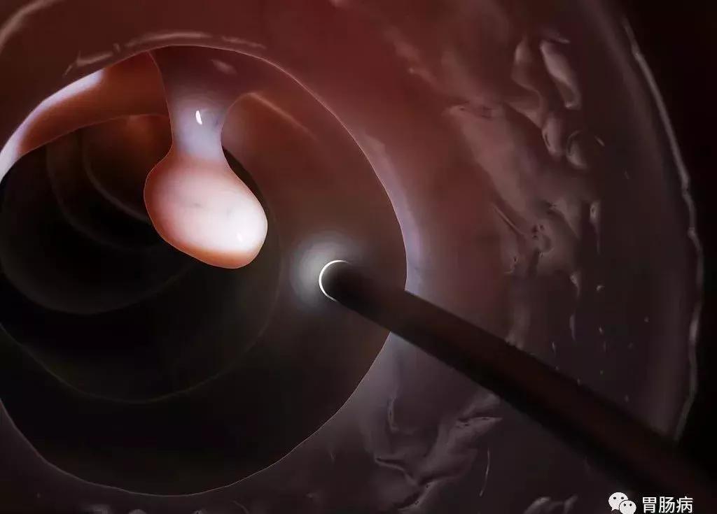 大肠息肉到大肠癌早期要多长时间,大肠息肉癌早期10大征兆