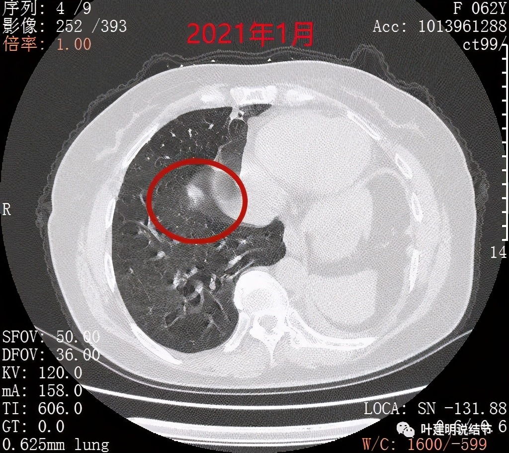 左肺癌手术半年右肺下角还有炎症,左下肺癌晚期