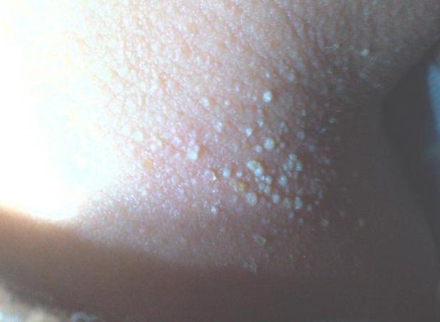 宝宝热痱子怎样护理,宝宝夏天痱子一招搞定