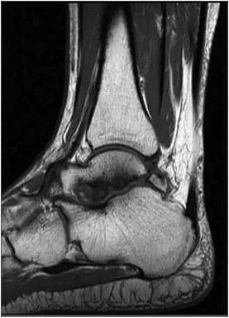 踝关节撞击症问诊,踝关节内侧撞击综合症位置图