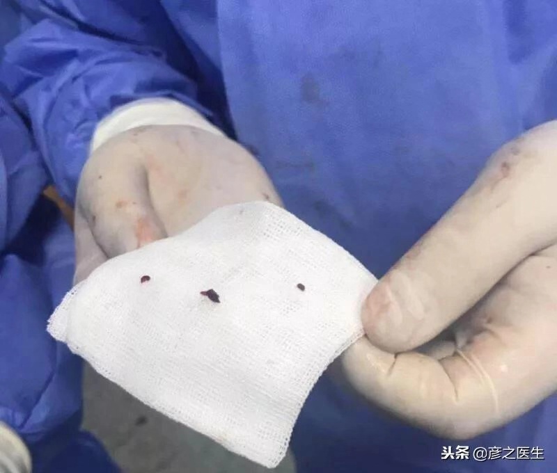 换瓣术后抗凝指南,换瓣术后抗凝不好有什么后果