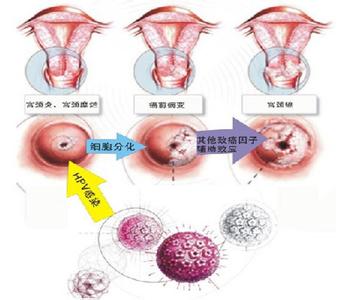 妇科检查宫颈囊肿严重吗,宫颈囊肿的危害有哪些呢