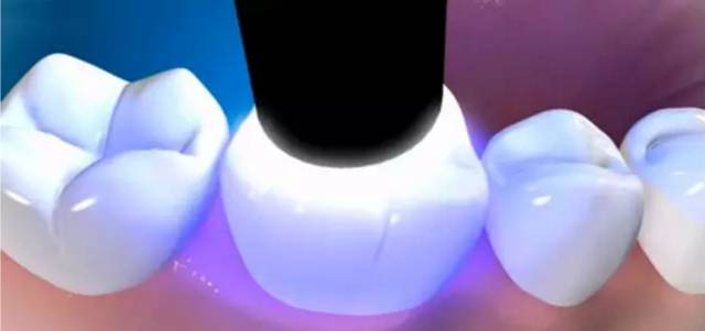 补牙最详细的过程来了，你还会看不懂吗？