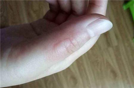 做饭被油溅伤脸怎么处理,手烫伤后能做家务吗