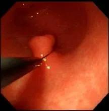 胃息肉一定能癌变吗,胃息肉会癌变吗