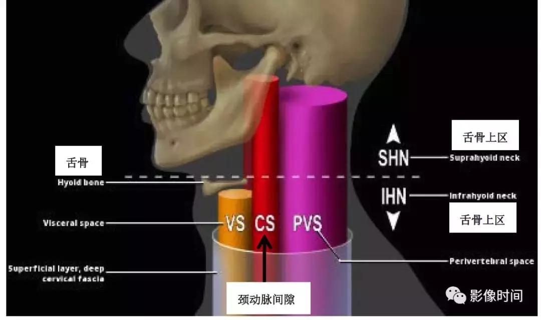 双侧颈动脉鞘间隙多发小淋巴结影,双侧颈动脉间隙多软组织密度结节