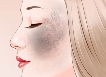 胎记真实身份,胎记是怎么形成的原因