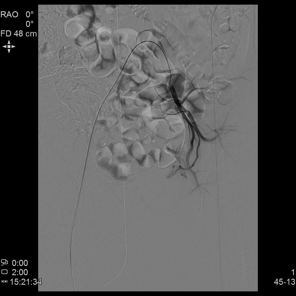 「不死的癌症」之克星——子宫腺肌症介入栓塞治疗