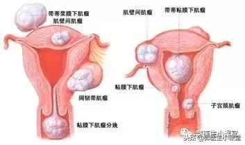 预防子宫肌瘤食谱,曼月环预防子宫肌瘤