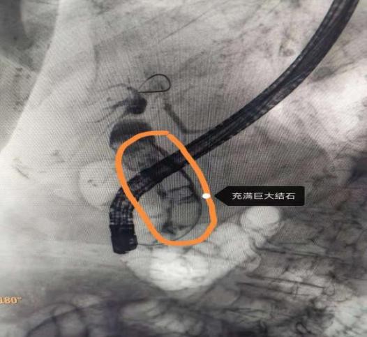 精益求精镜亦求净哈医大一院消化内科ERCP下取净胆管内2.5cm巨型结石