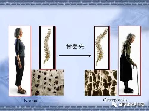 引起继发性骨质疏松症的病因,什么是退行性骨质病变