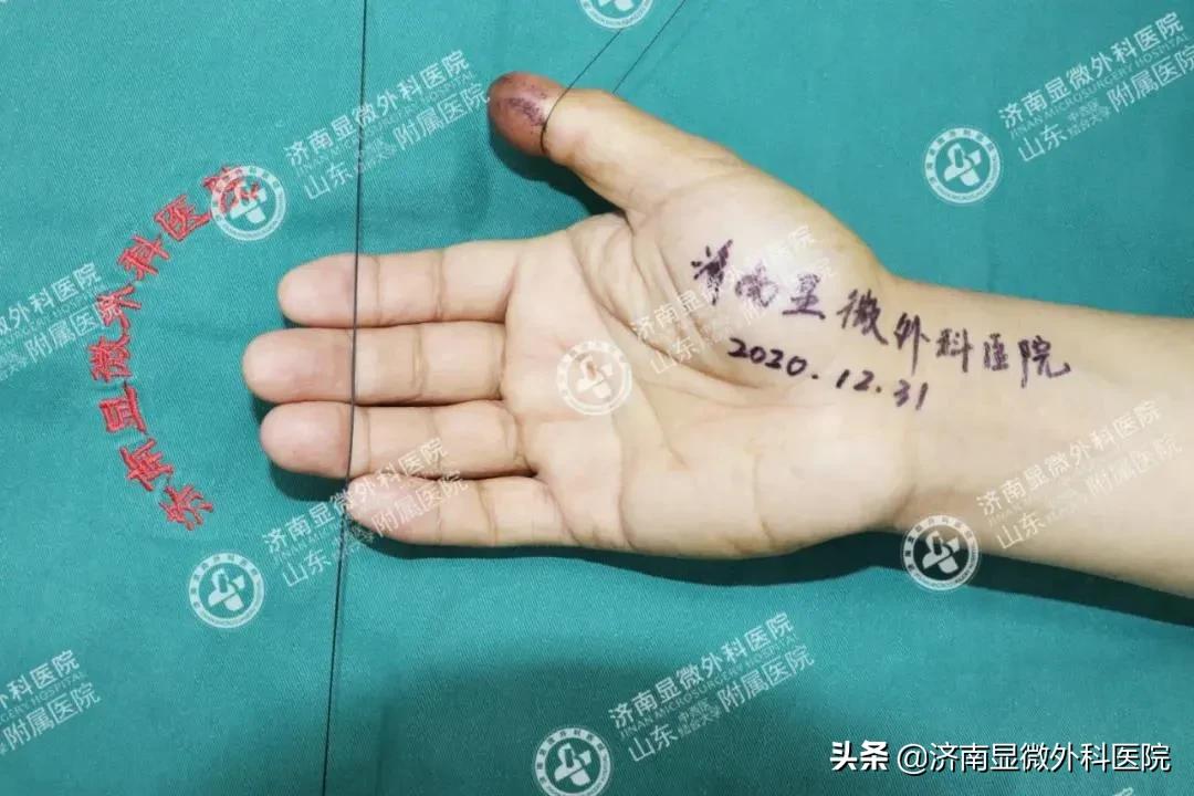 注意！失去一截手指不要灰心，这样做能重新复原它