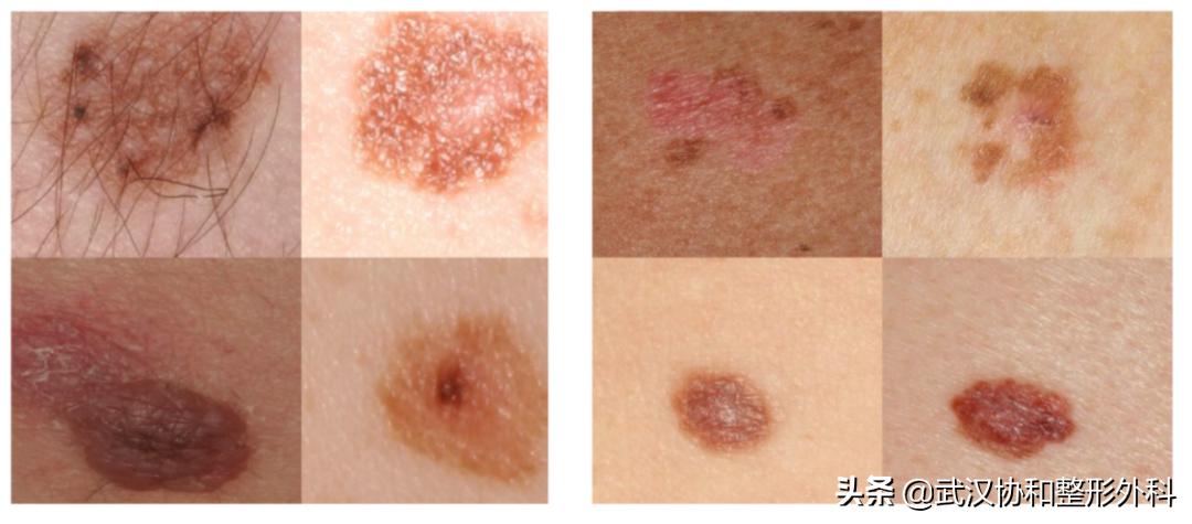 长了很多黑痣是什么原因,不规则的黑痣一定会癌变么