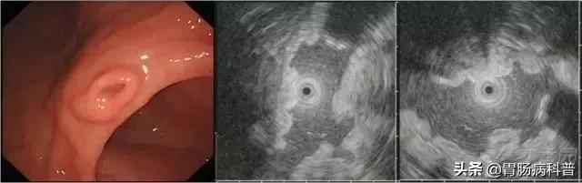 胃癌手术后一年胃镜说胃粘膜隆起,胃镜报告有隆起