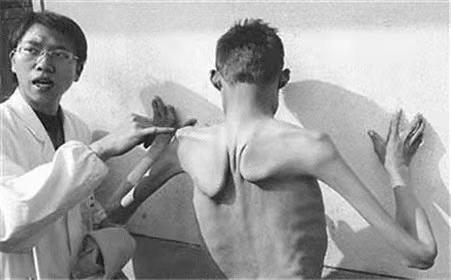 缺乏型肌营养不良,不是营养过剩而是营养失衡