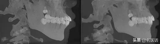戴牙套2年不戴保持器反弹案例,戴牙套成功案例不戴保持器