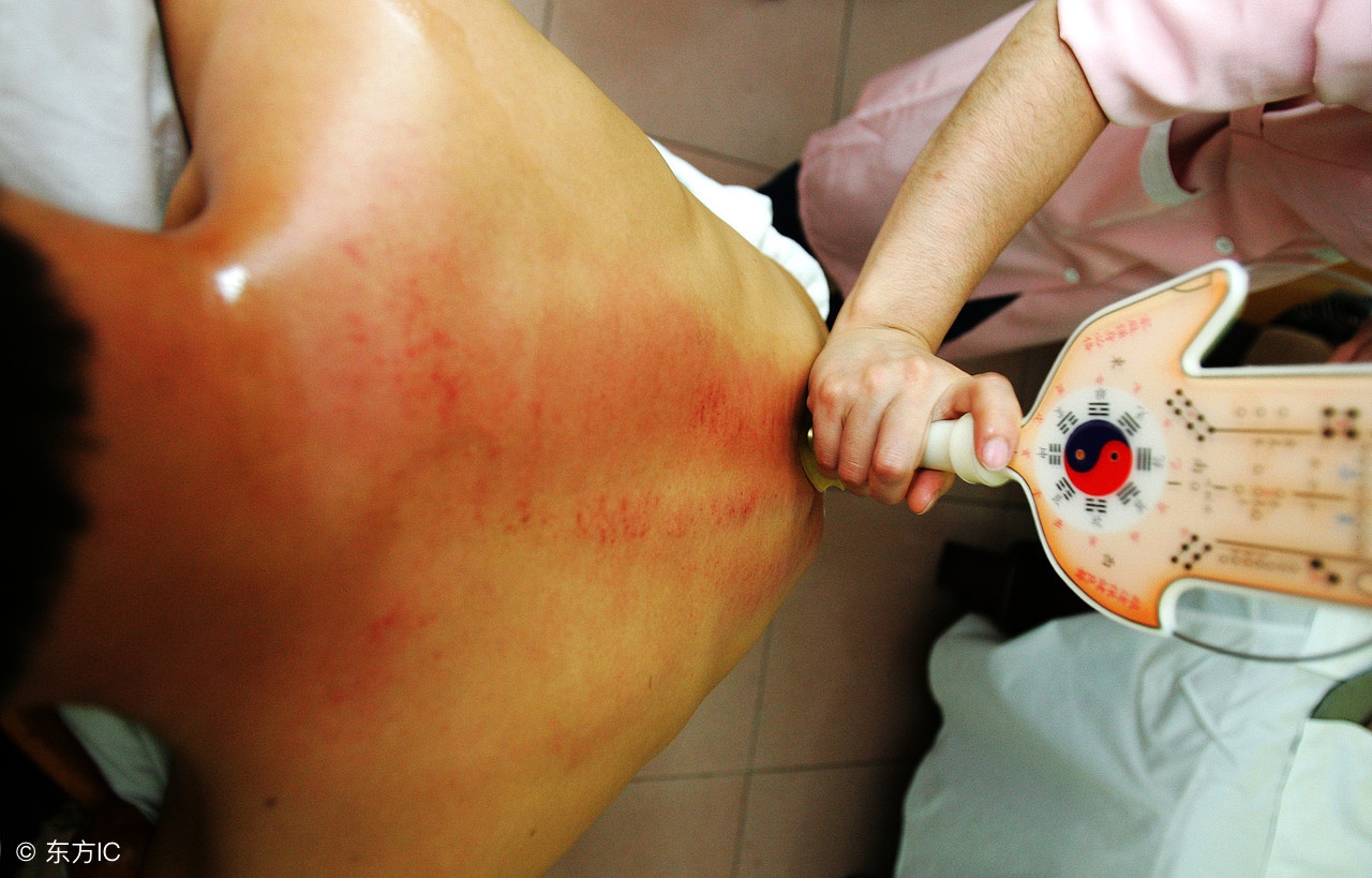 阿娇晒刮痧治疗照,阿娇背部刮痧图片