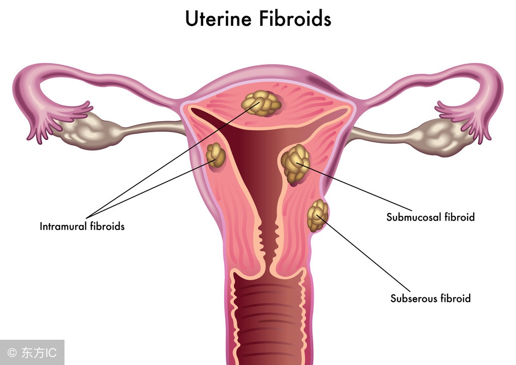6公分肌瘤医生让切子宫，要切吗？