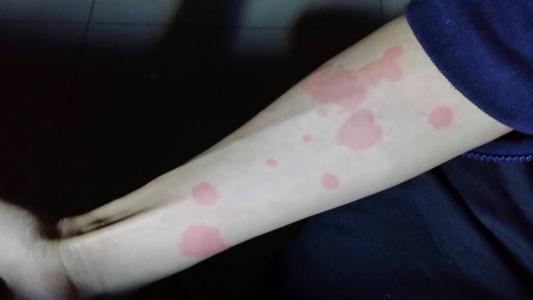 麻疹注意事项有哪些,麻疹最应警惕的并发症