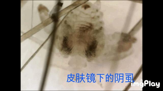 阴虱病如何传播,阴虱病是怎么传播来的