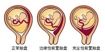 高龄产妇顺产有什么风险,高龄产妇怀孕的风险有哪些