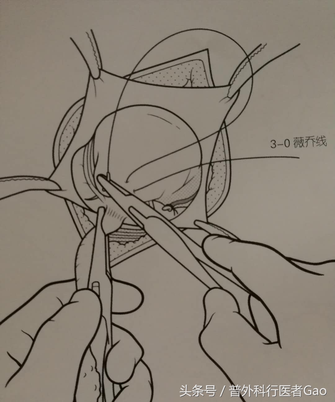 鏉忎粊鑳芥不闃戝熬鐐庡悧,鏉忎粊鍒囬櫎