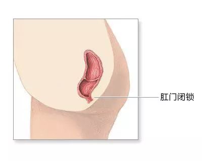 东莞男婴生下来没有肛门!愁坏了父母,憋坏了孩子……医生……