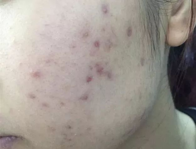 祛痘和祛痘印先用哪个好,祛痘印和祛痘坑哪个效果好