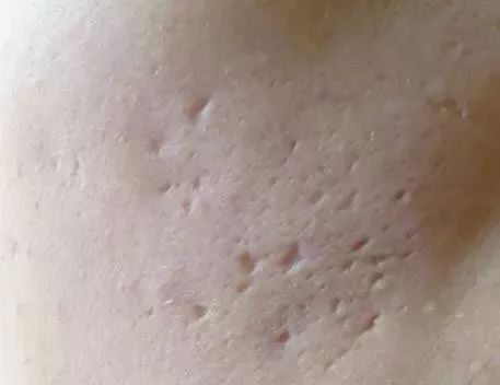 祛痘和祛痘印先用哪个好,祛痘印和祛痘坑哪个效果好