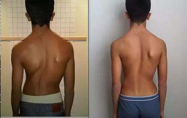 孩子脊柱弯了怎么矫正视频,孩子的脊柱怎么弯