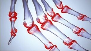 类风湿性关节炎熏蒸中药方,类风湿关节炎用中药熏蒸效果好吗