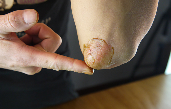 中医治疗湿疹是让湿疹发出来吗,春天湿疹用哪个中成药