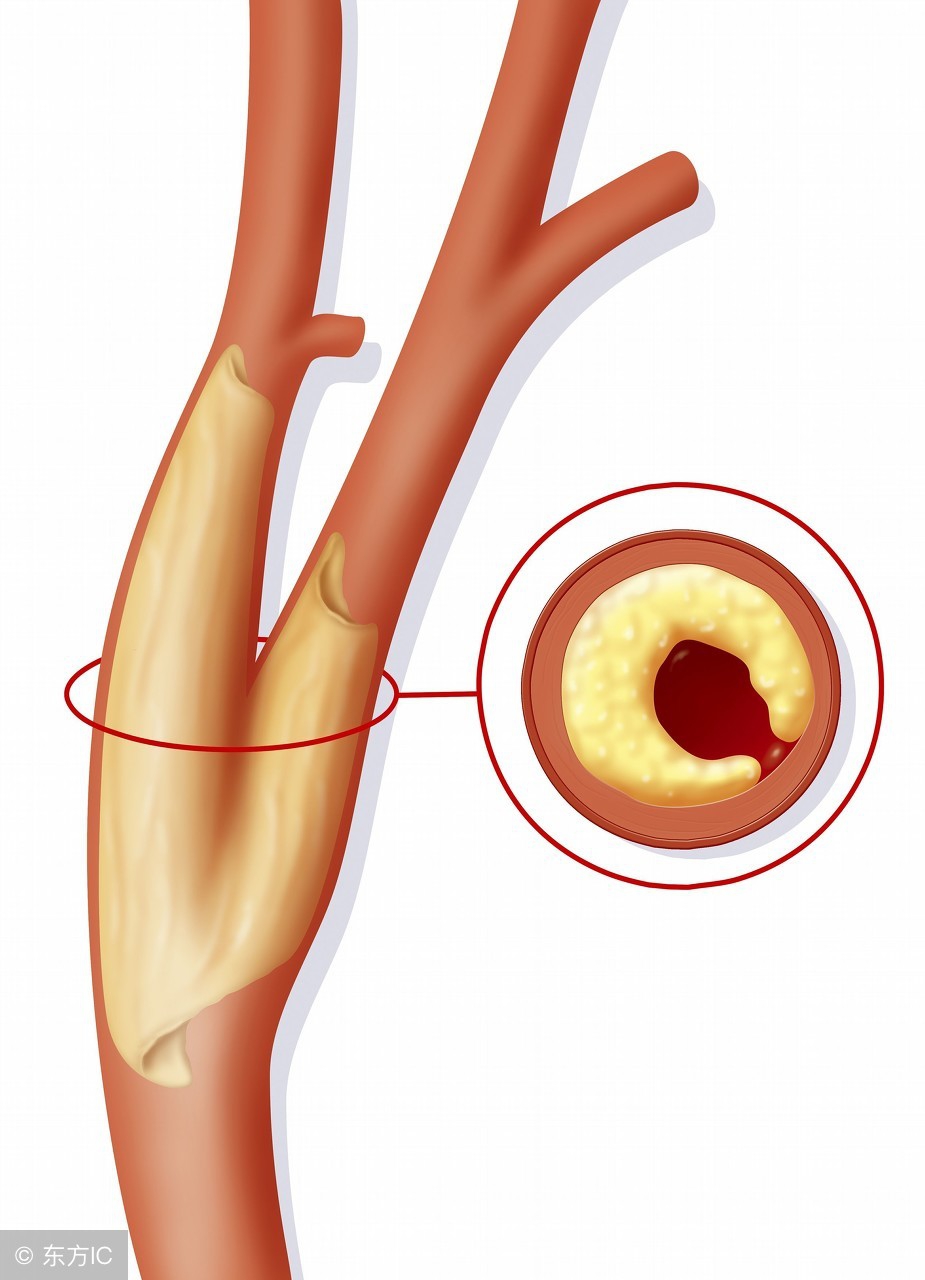 治疗方法选对，颈动脉斑块不需要害怕