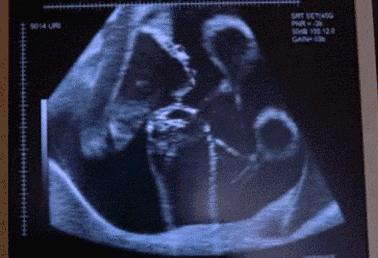 孕期胎动看出宝宝性格吗,孕期产检你知道多少呢