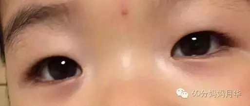 春季宝宝降肝火,春季孩子肝火旺怎么推拿